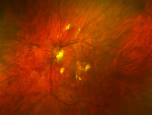 Diabetic-Retinopathy_lr